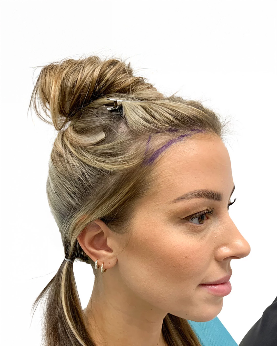 Josephine före hårtransplantationen