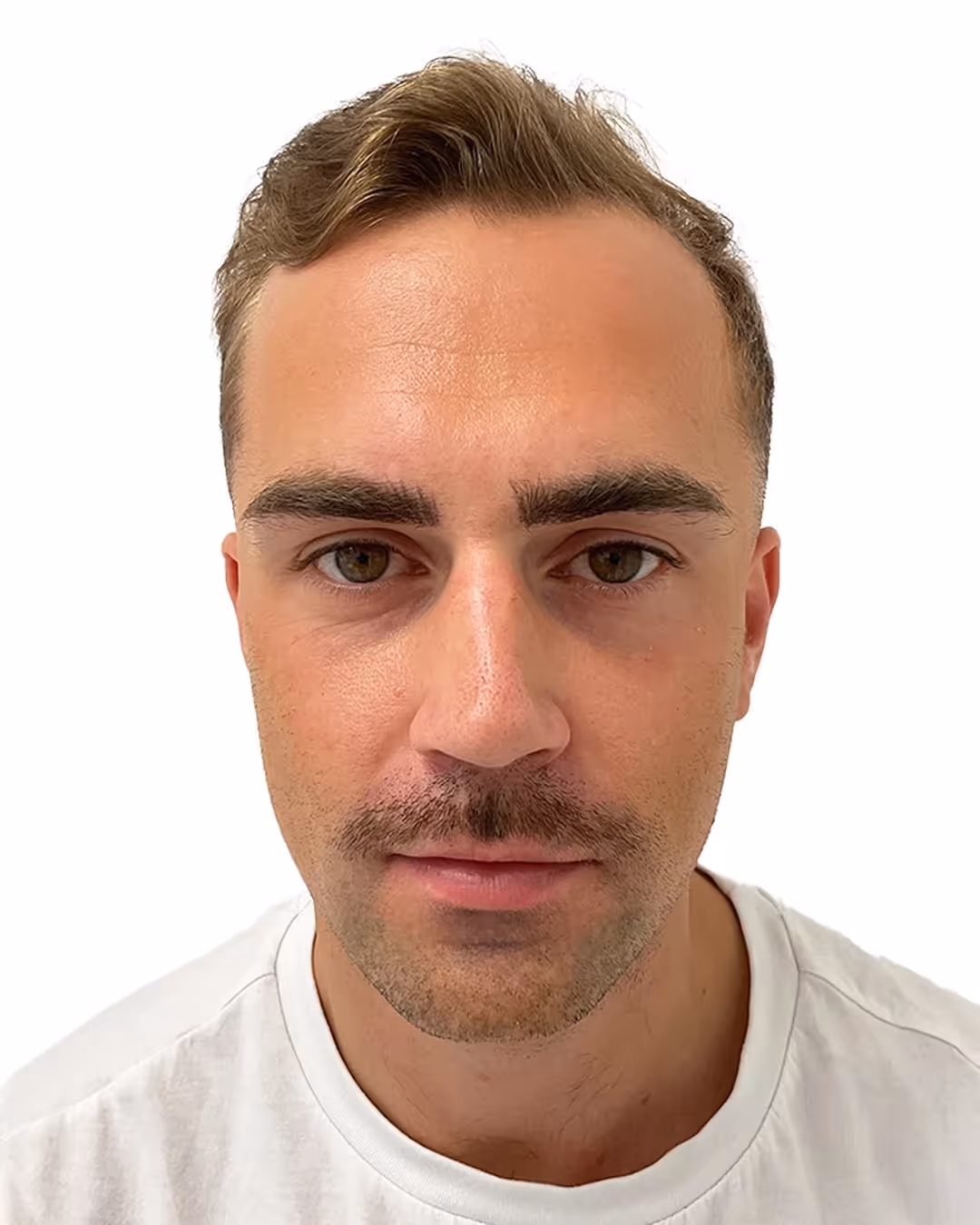 Joakim före hårbehandlingen