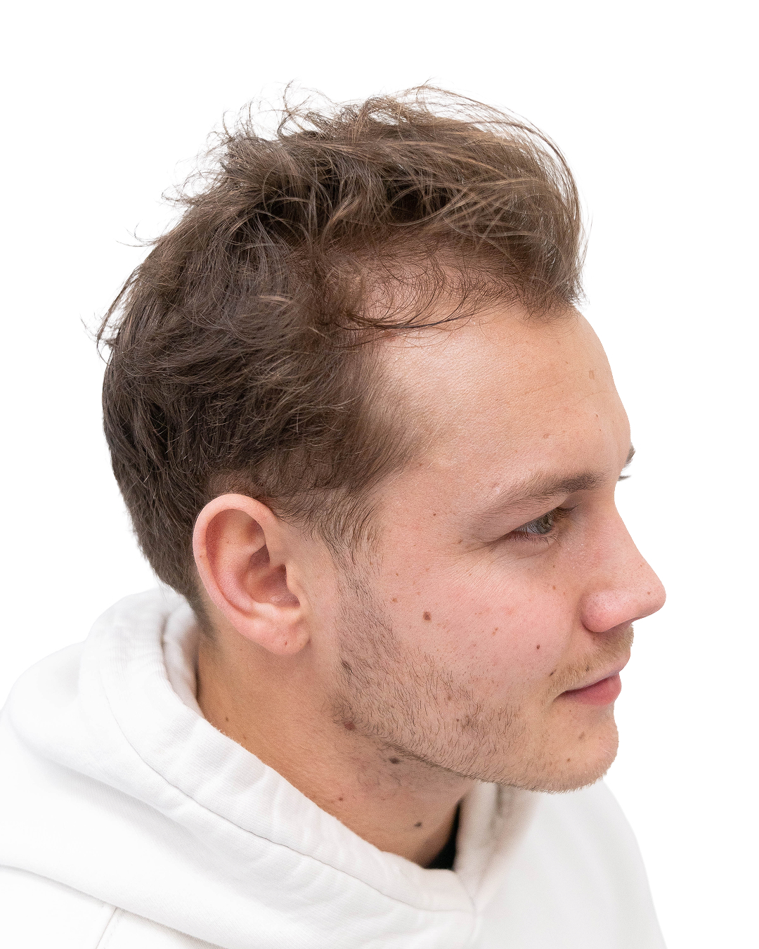 Jesper före hårbehandlingen