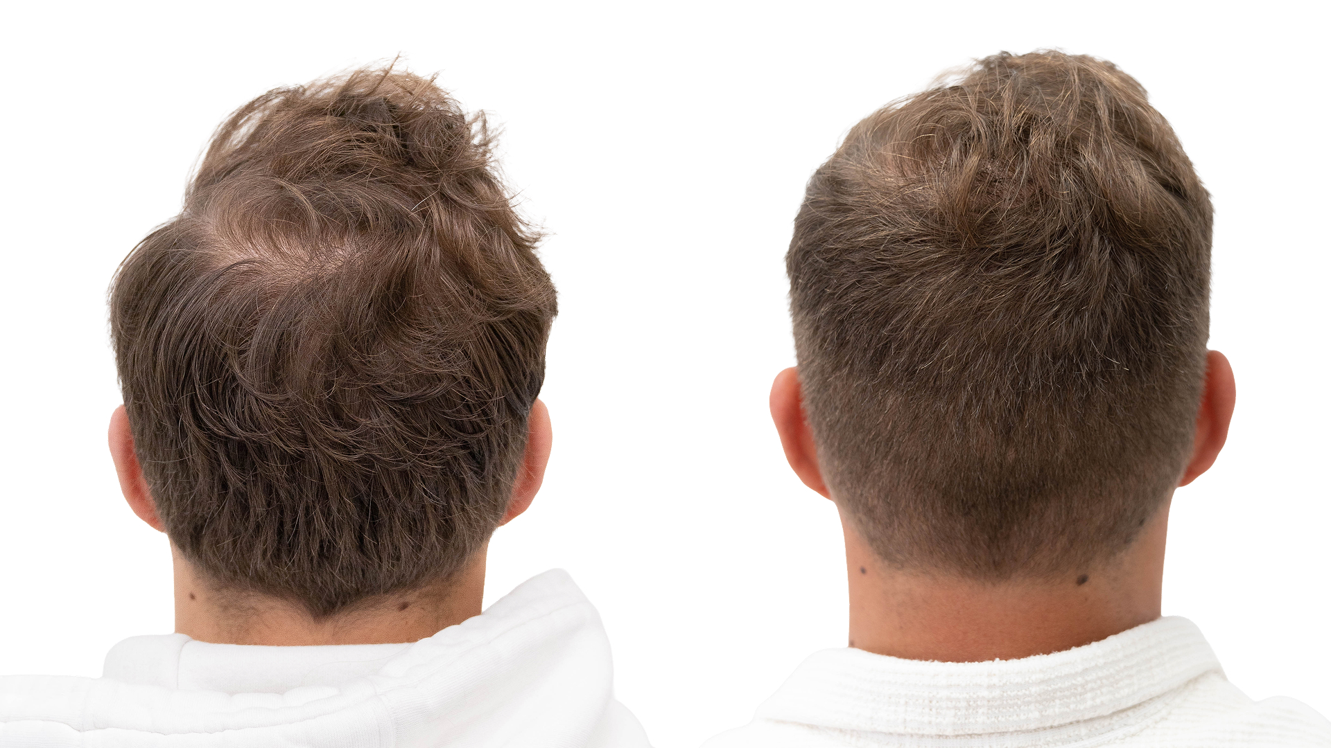 Jesper – före och efter sin hårbehandling