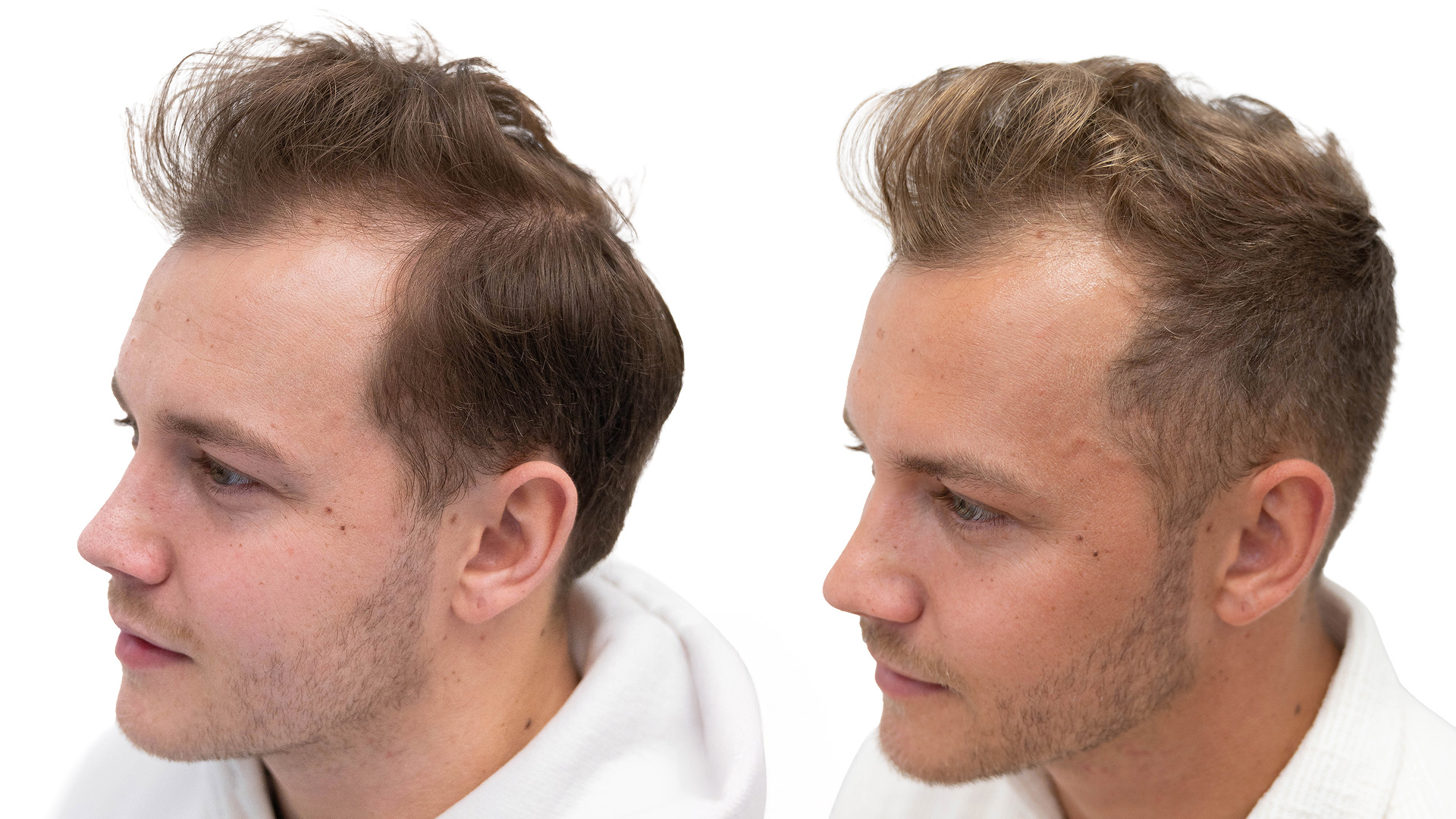 Jesper – före och efter sin hårbehandling