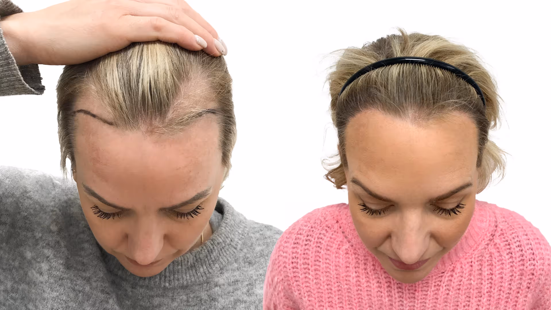 Jennie – före och efter sin hårtransplantation