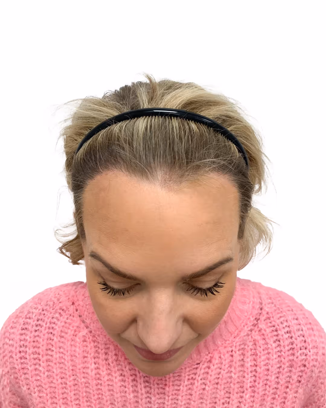 Jennie efter hårtransplantationen