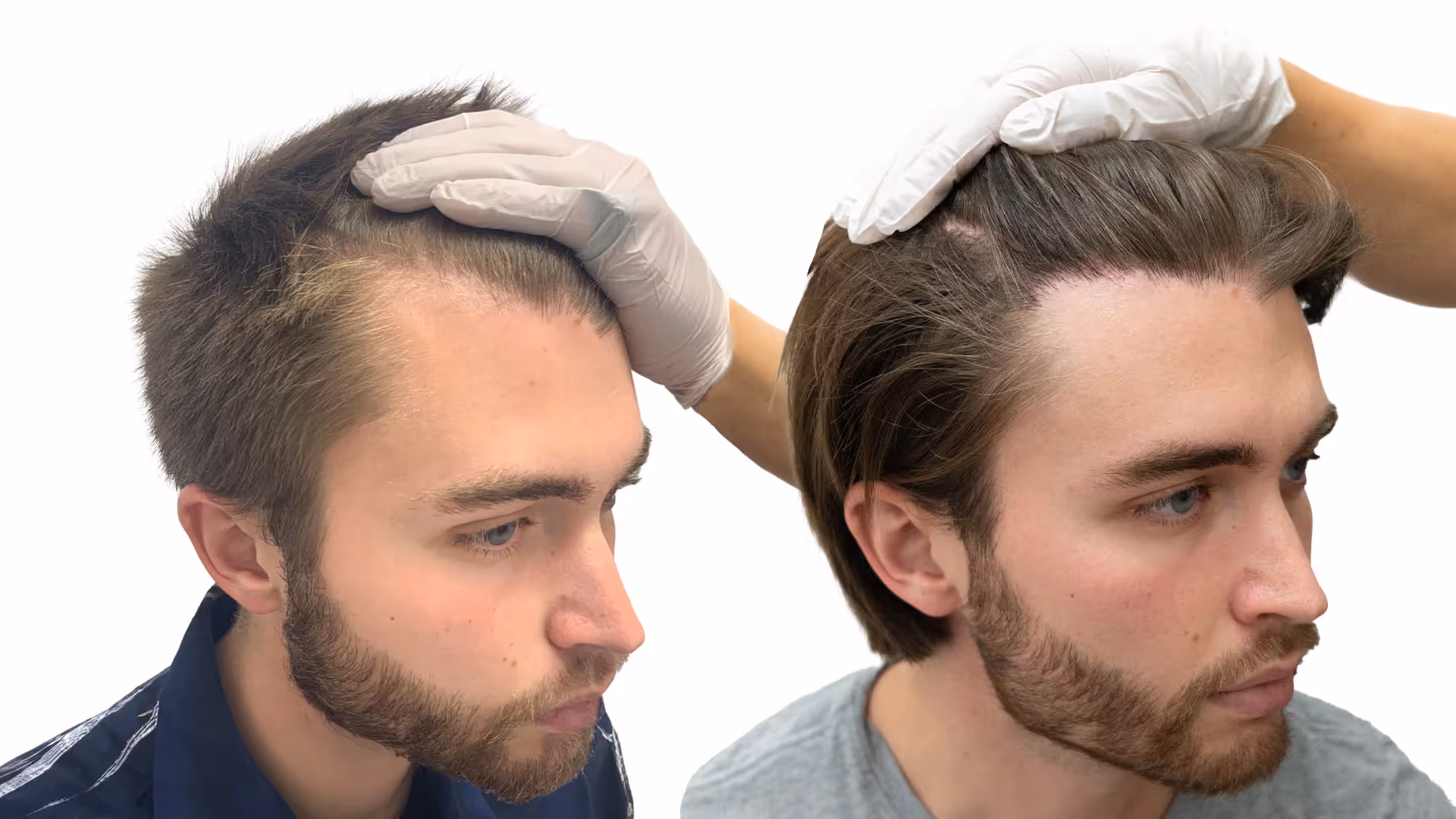 Isak – före och efter sin hårtransplantation