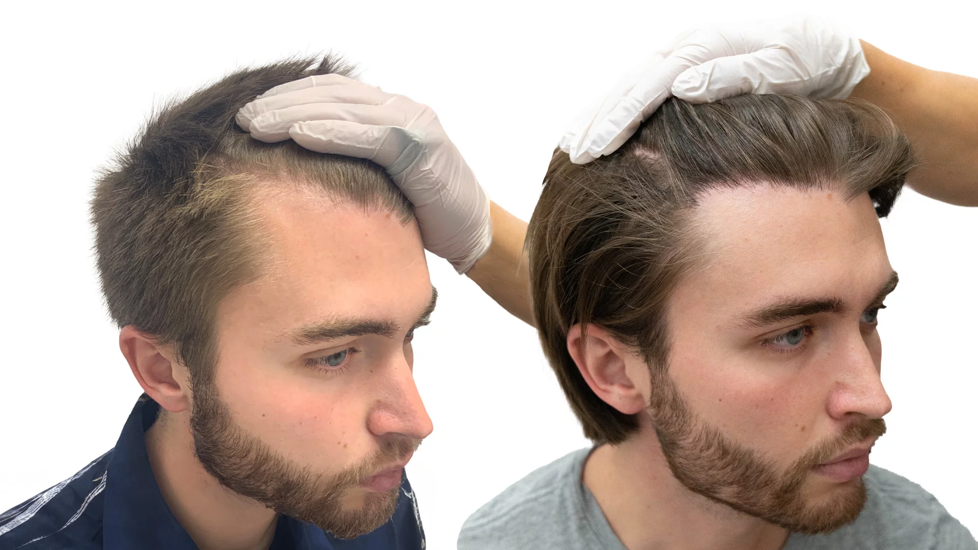 Isak – före och efter sin hårtransplantation