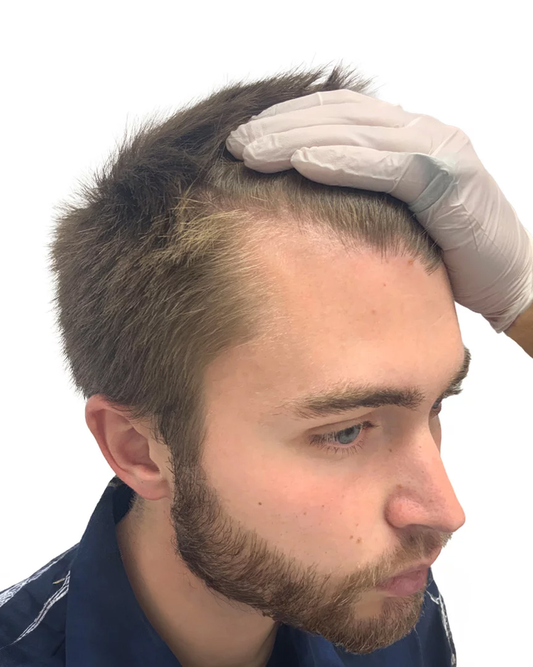 Isak före hårtransplantationen