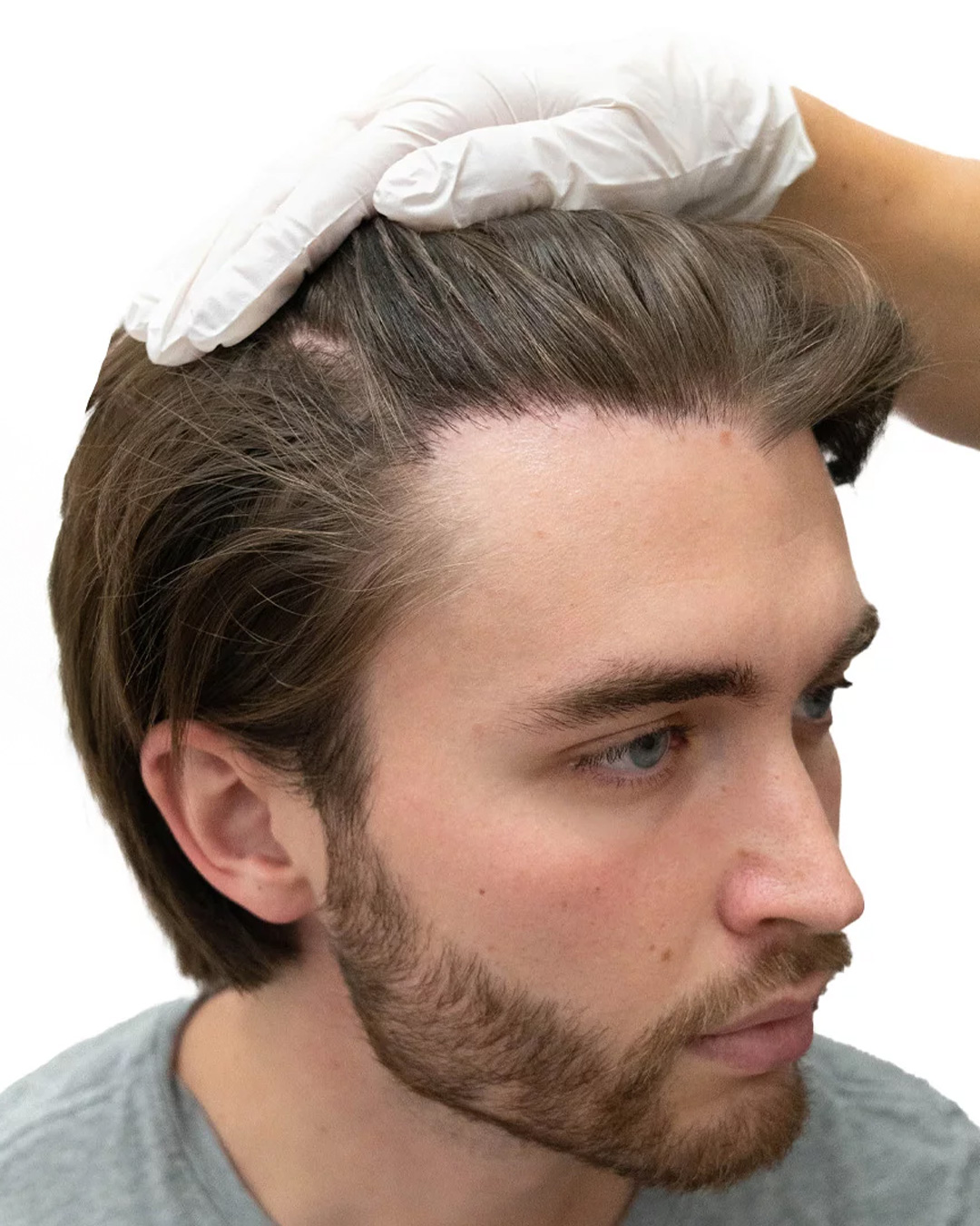 Isak efter hårtransplantationen