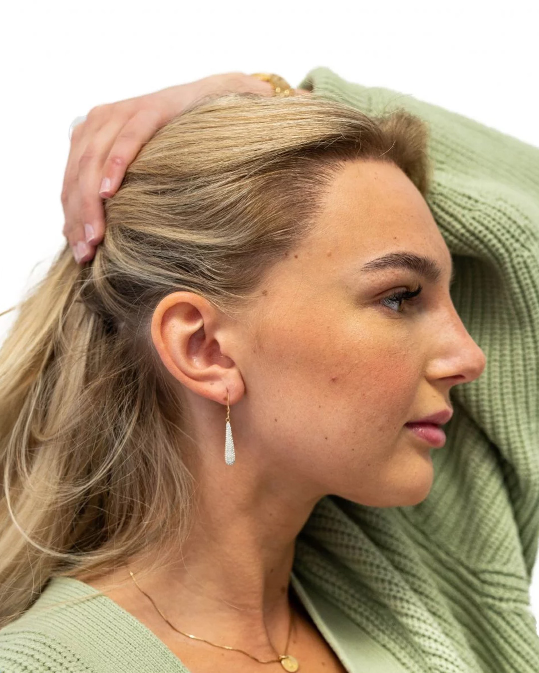 Ida efter hårtransplantationen