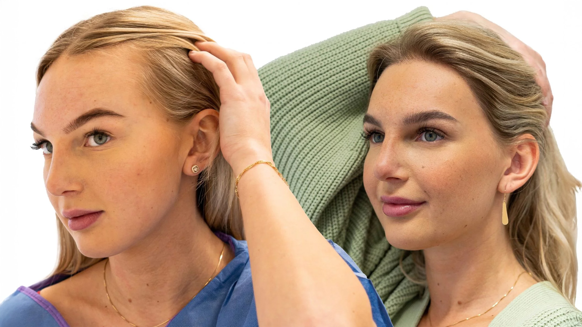 Ida – före och efter sin hårtransplantation