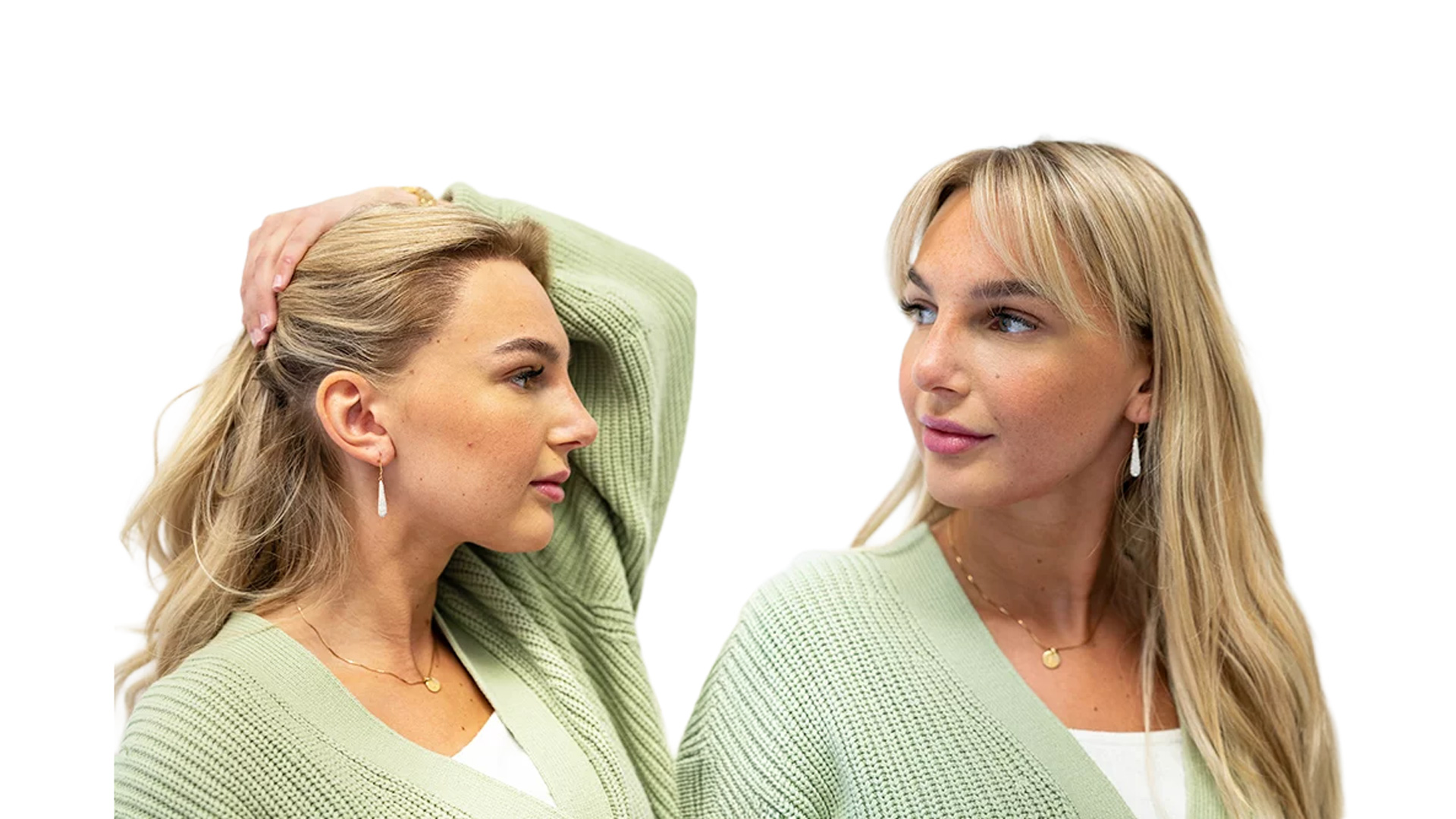 Ida – före och efter sin hårtransplantation