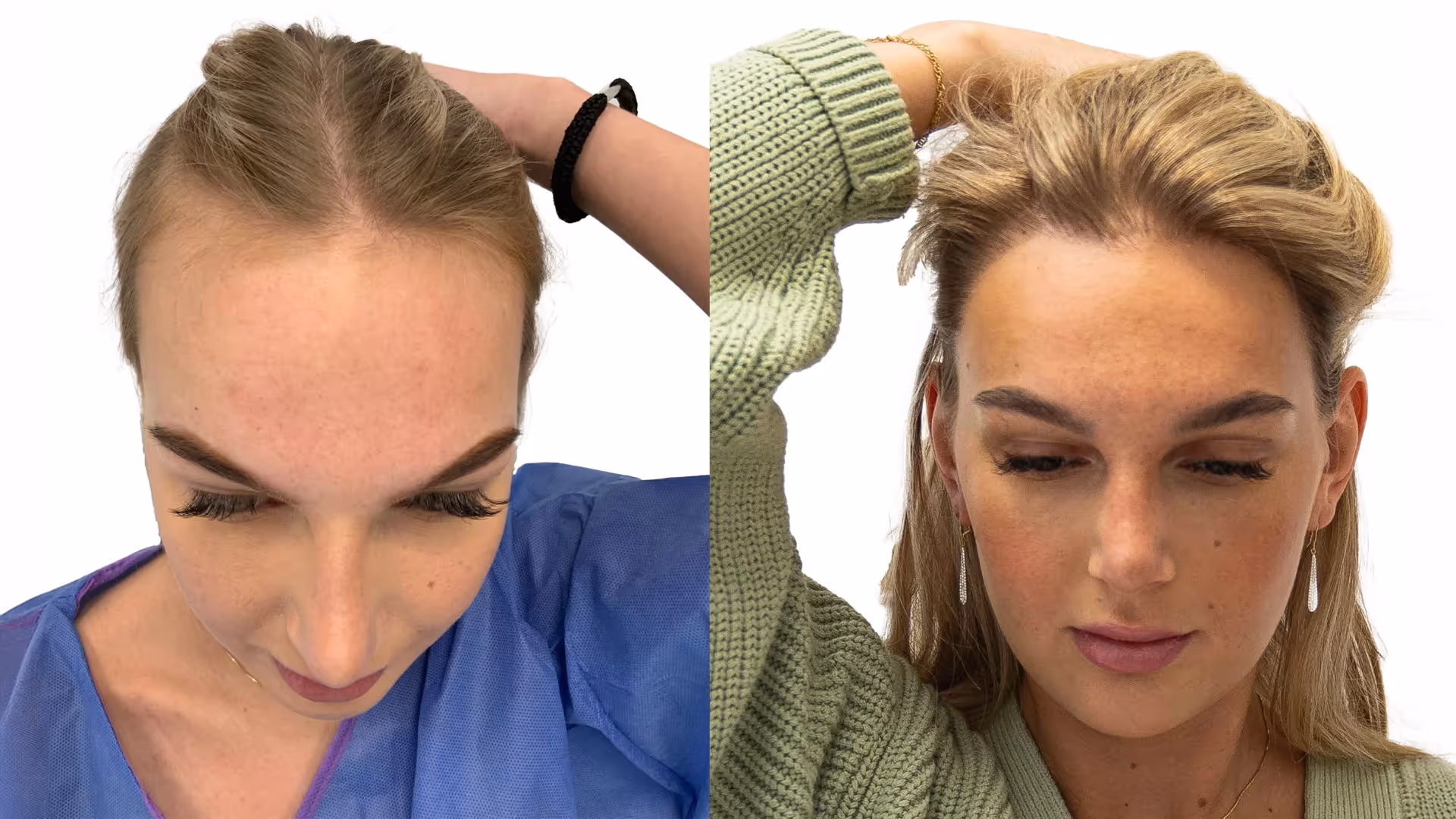 Ida – före och efter sin hårtransplantation