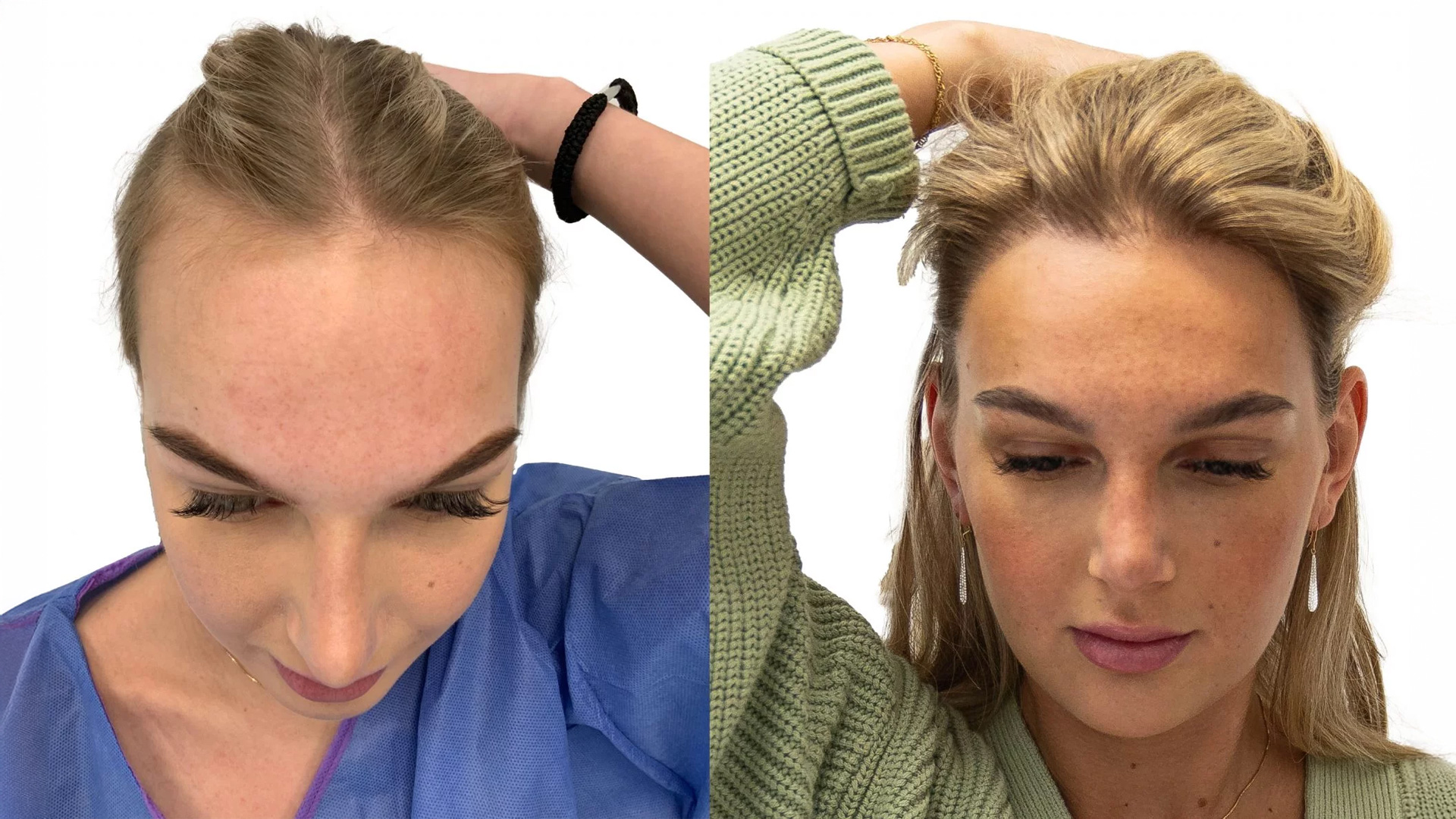 Ida – före och efter sin hårtransplantation