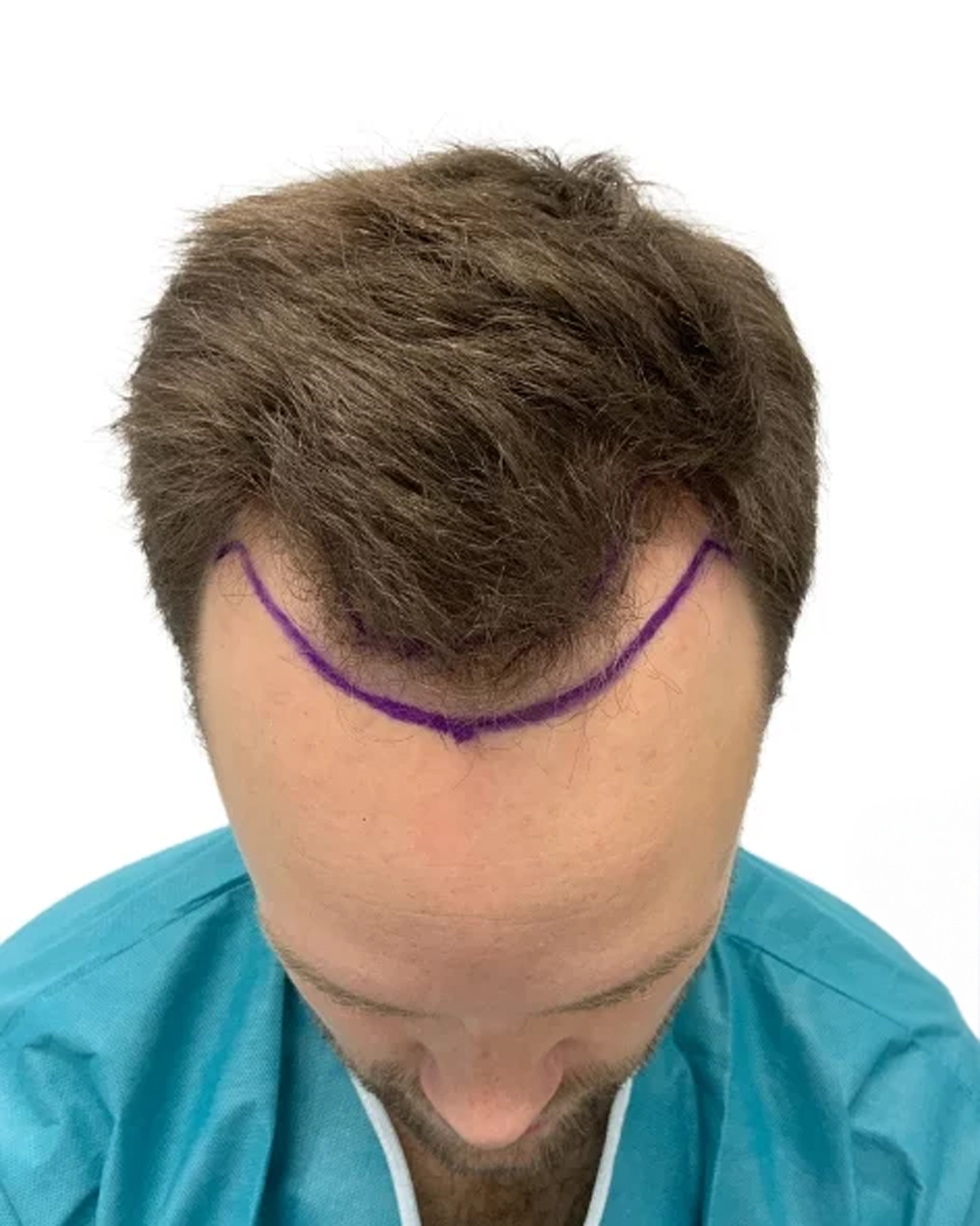 Henrik före hårtransplantationen