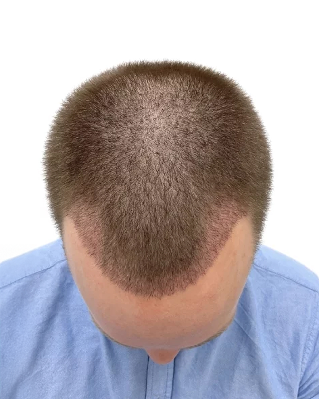 Henrik efter hårtransplantationen