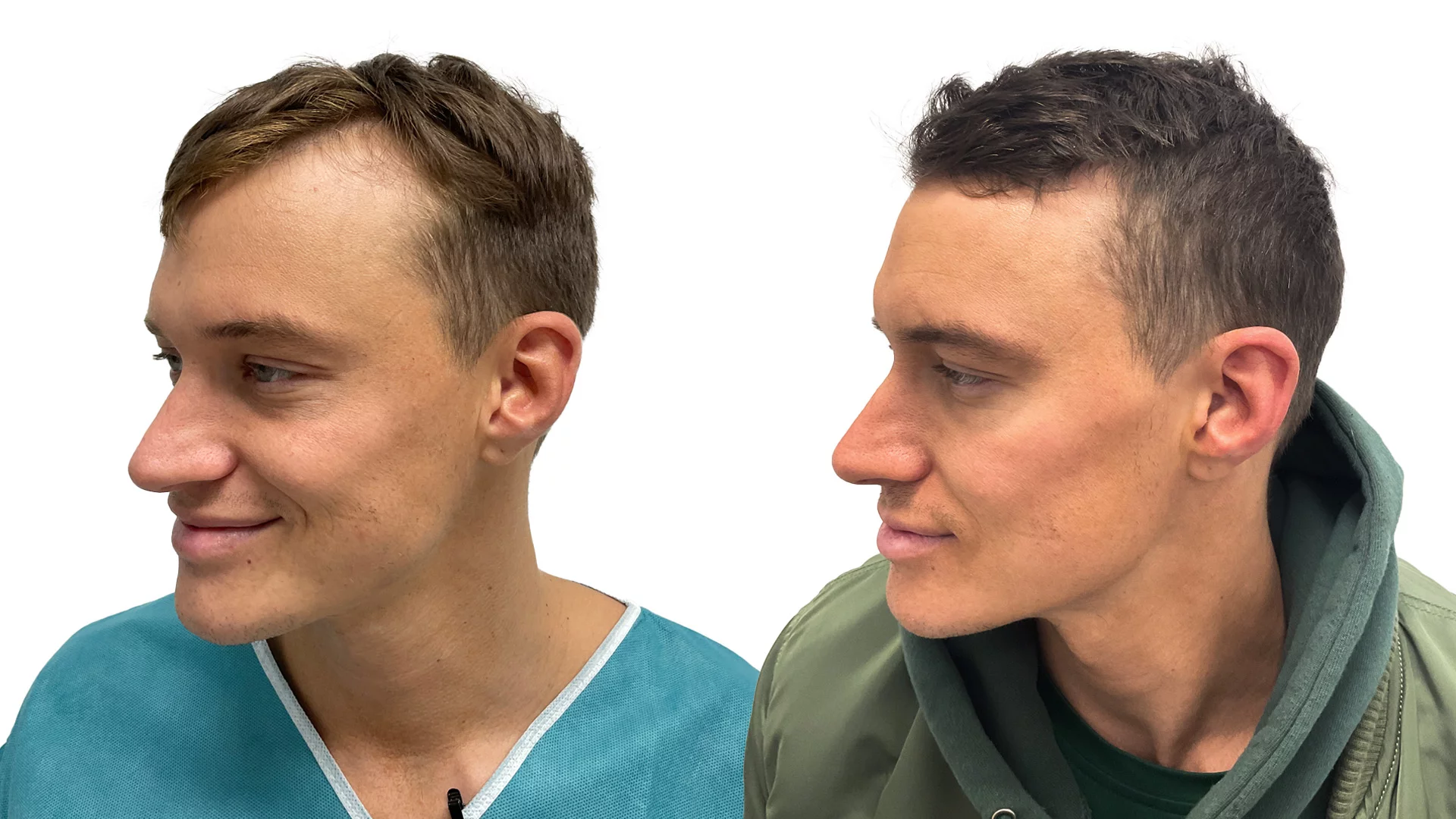 Henrik – före och efter sin hårtransplantation