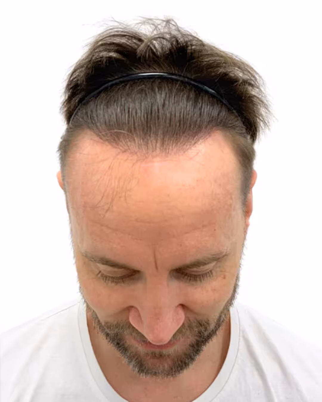 Franz efter hårtransplantationen