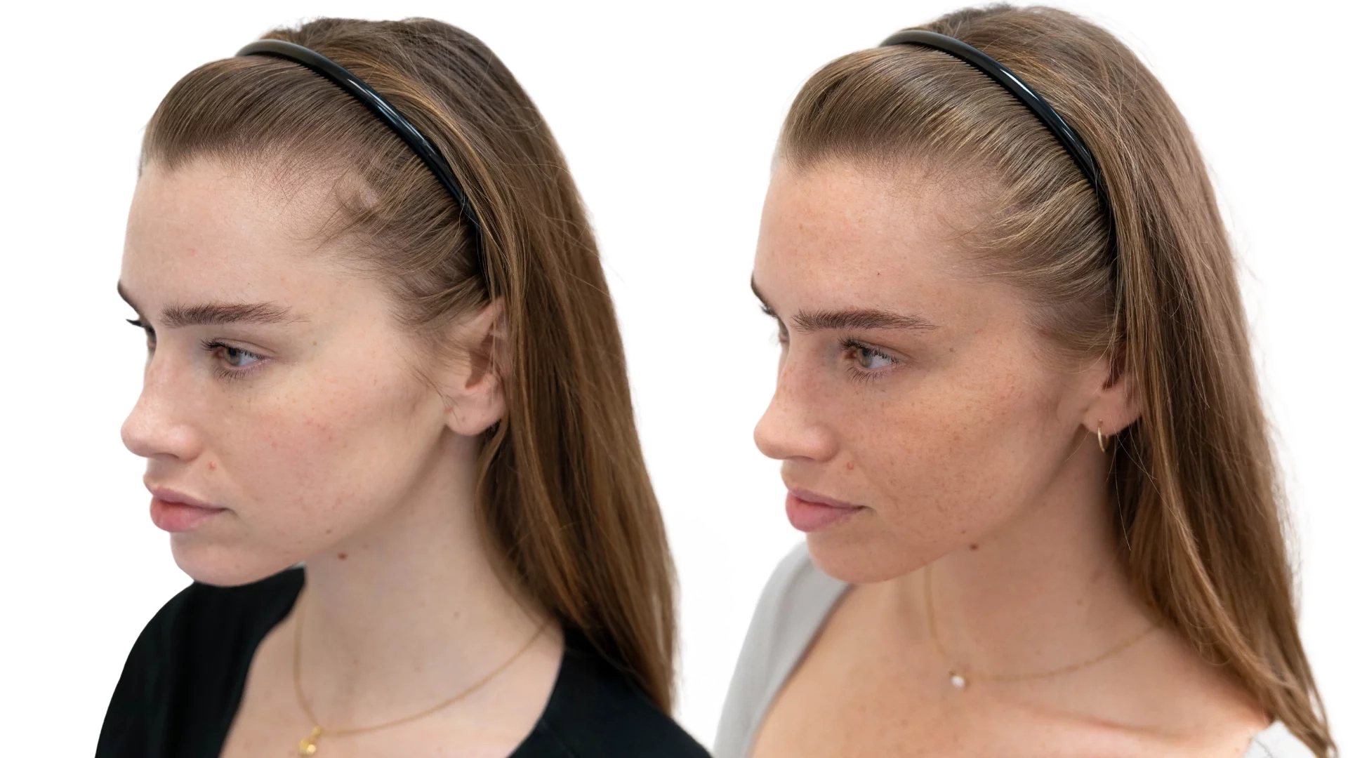 Emilia – före och efter sin hårbehandling