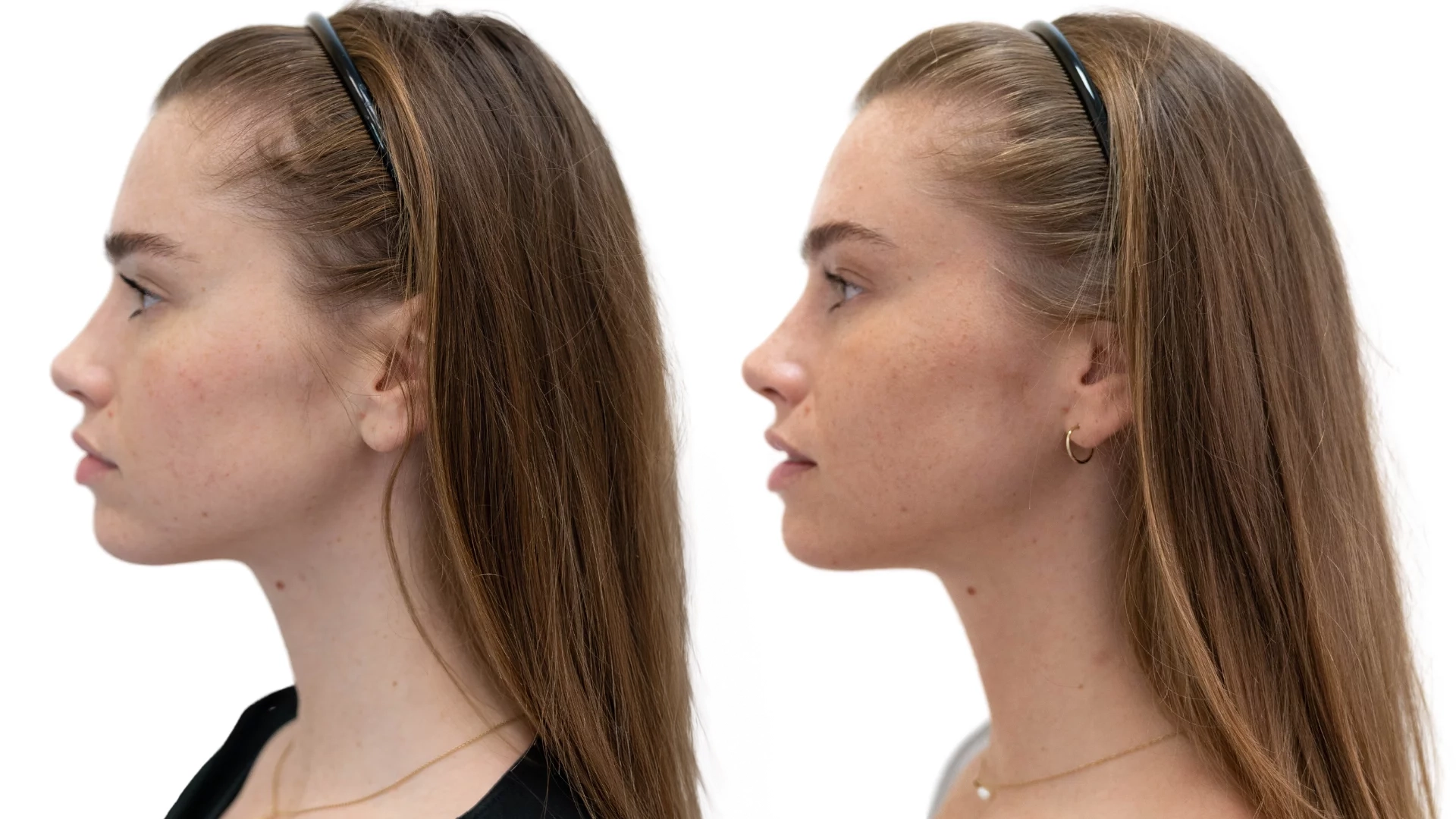 Emilia – före och efter sin hårbehandling