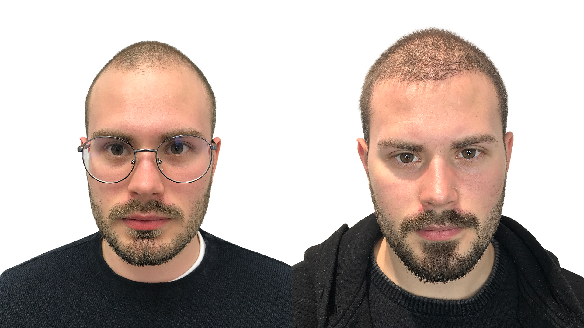 Elias – före och efter sin hårtransplantation