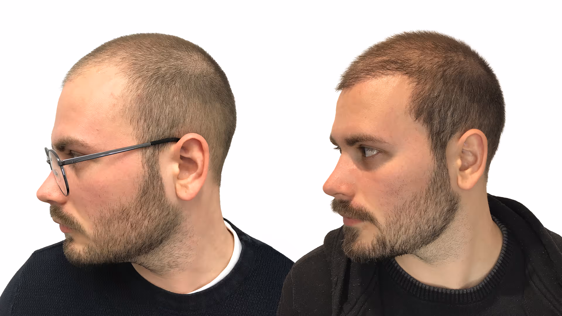 Elias – före och efter sin hårtransplantation