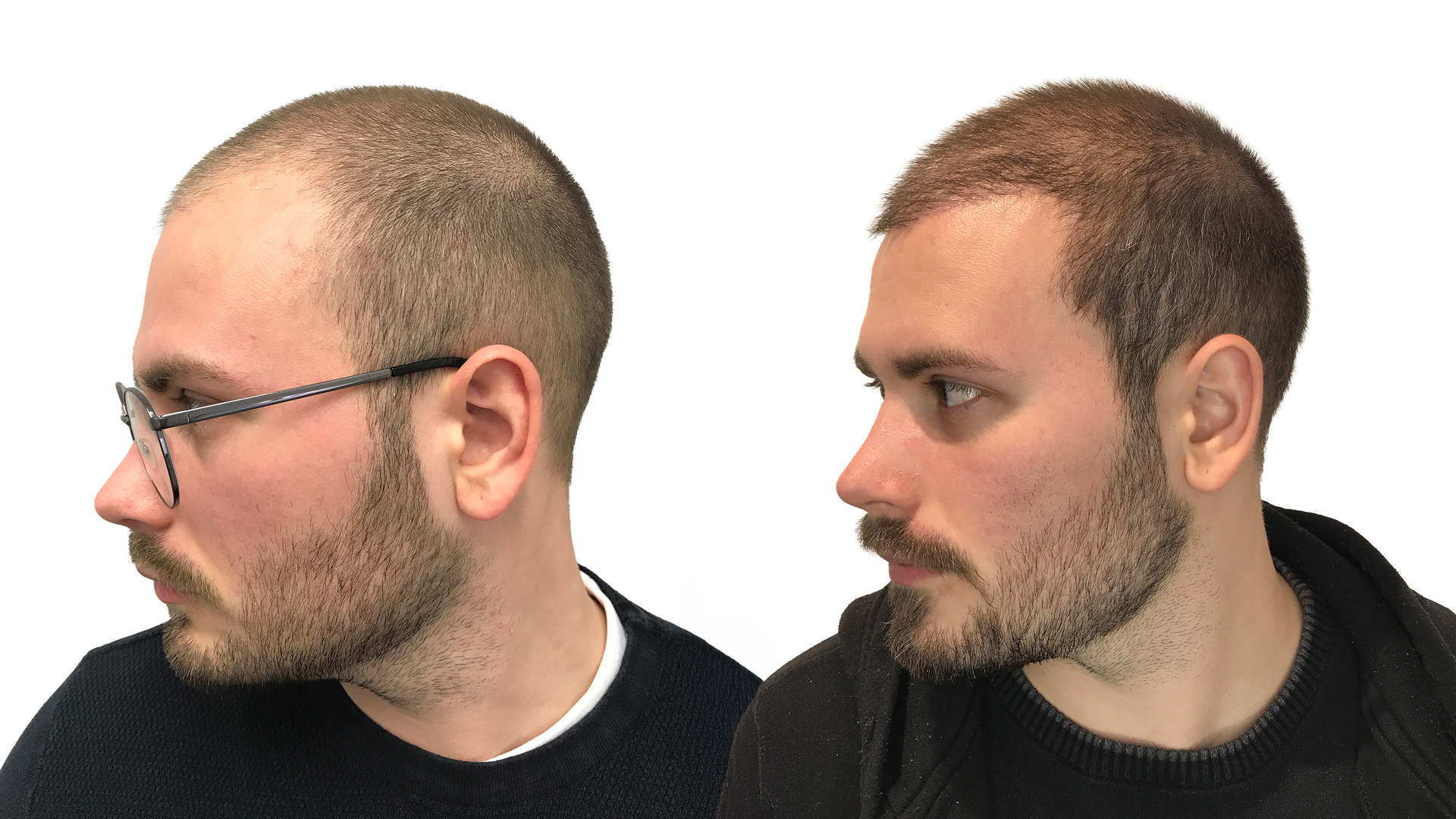 Elias – före och efter sin hårtransplantation