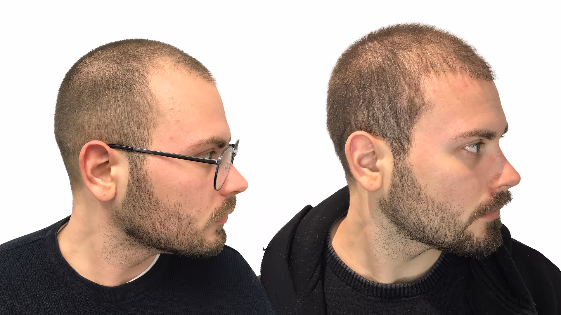 Elias – före och efter sin hårtransplantation