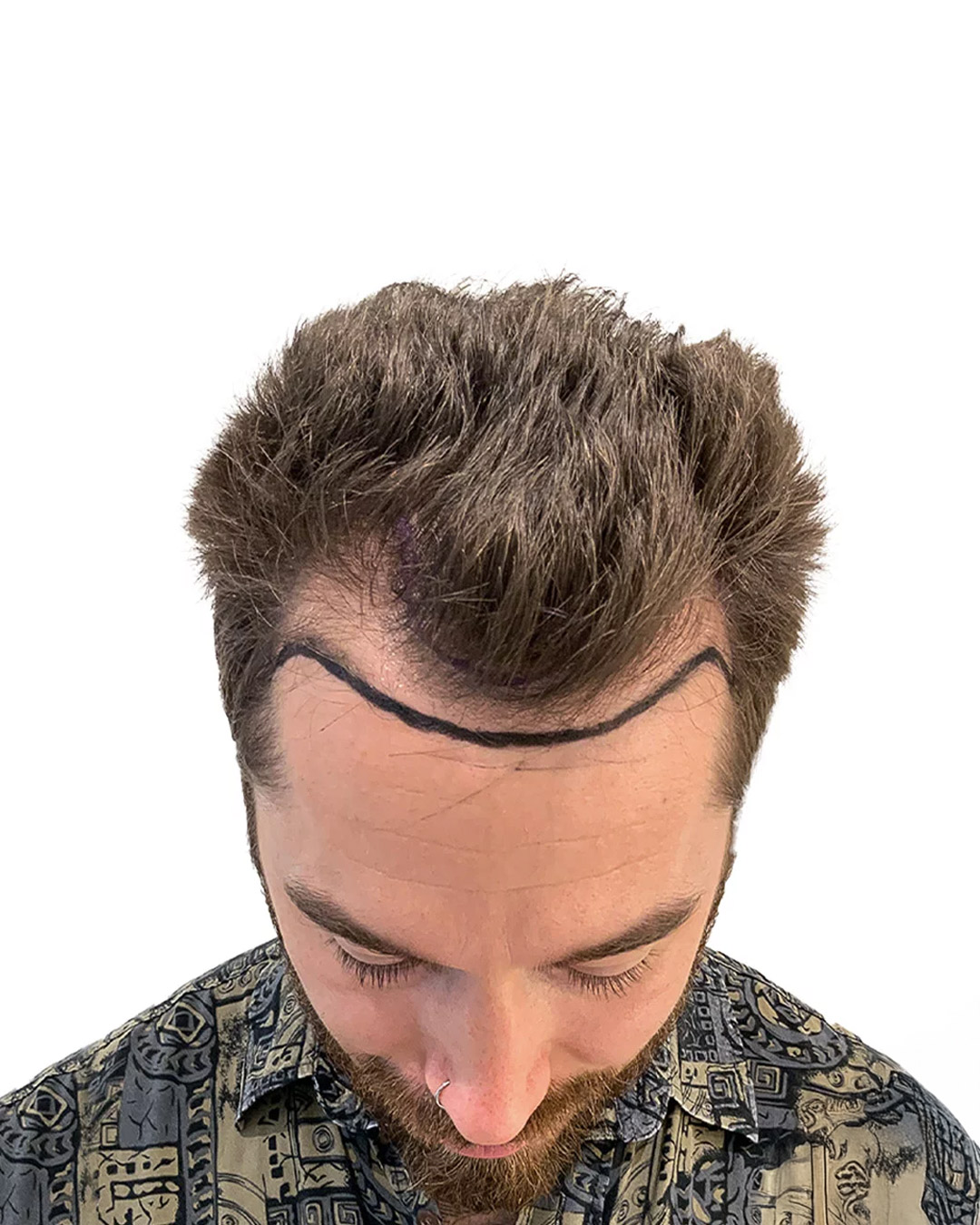 David före hårtransplantationen