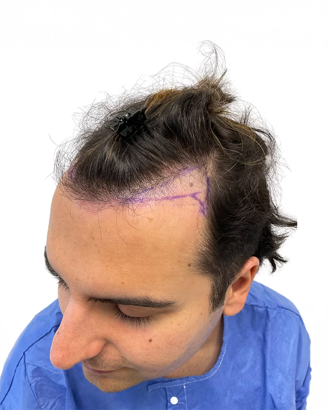 Daniel före hårtransplantationen