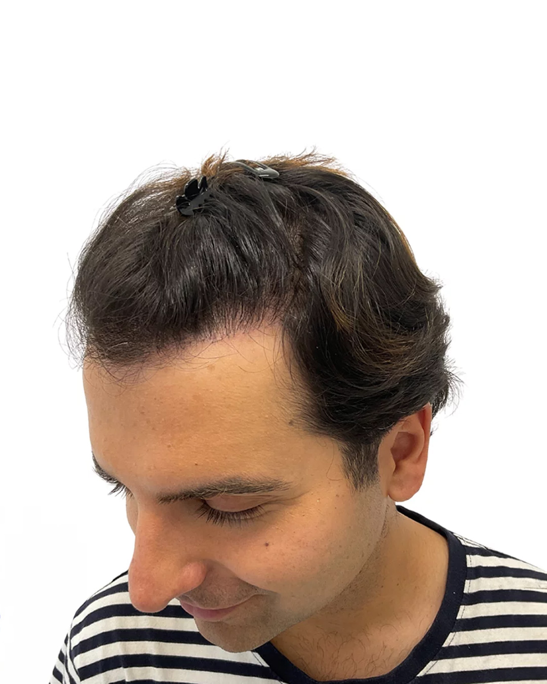 Daniel efter hårtransplantationen