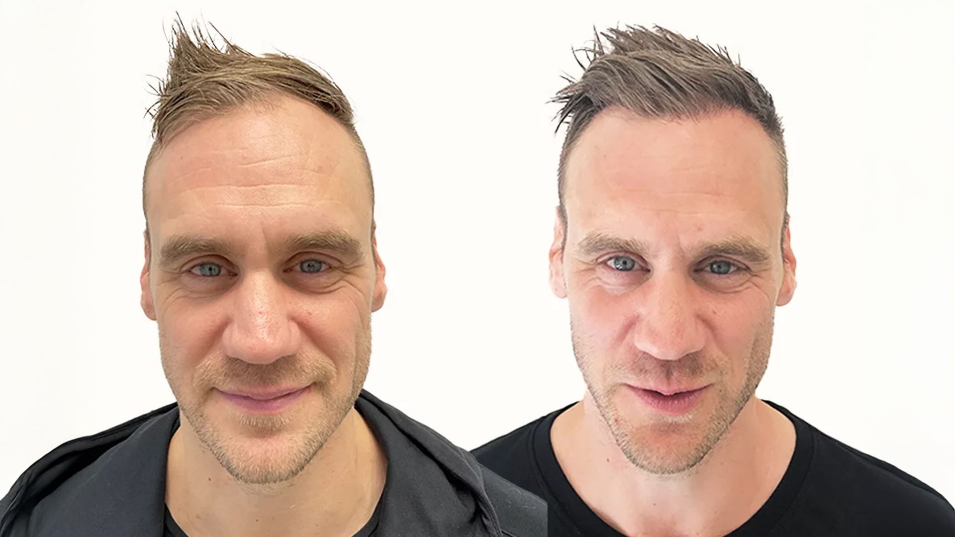 Christer – före och efter sin hårtransplantation