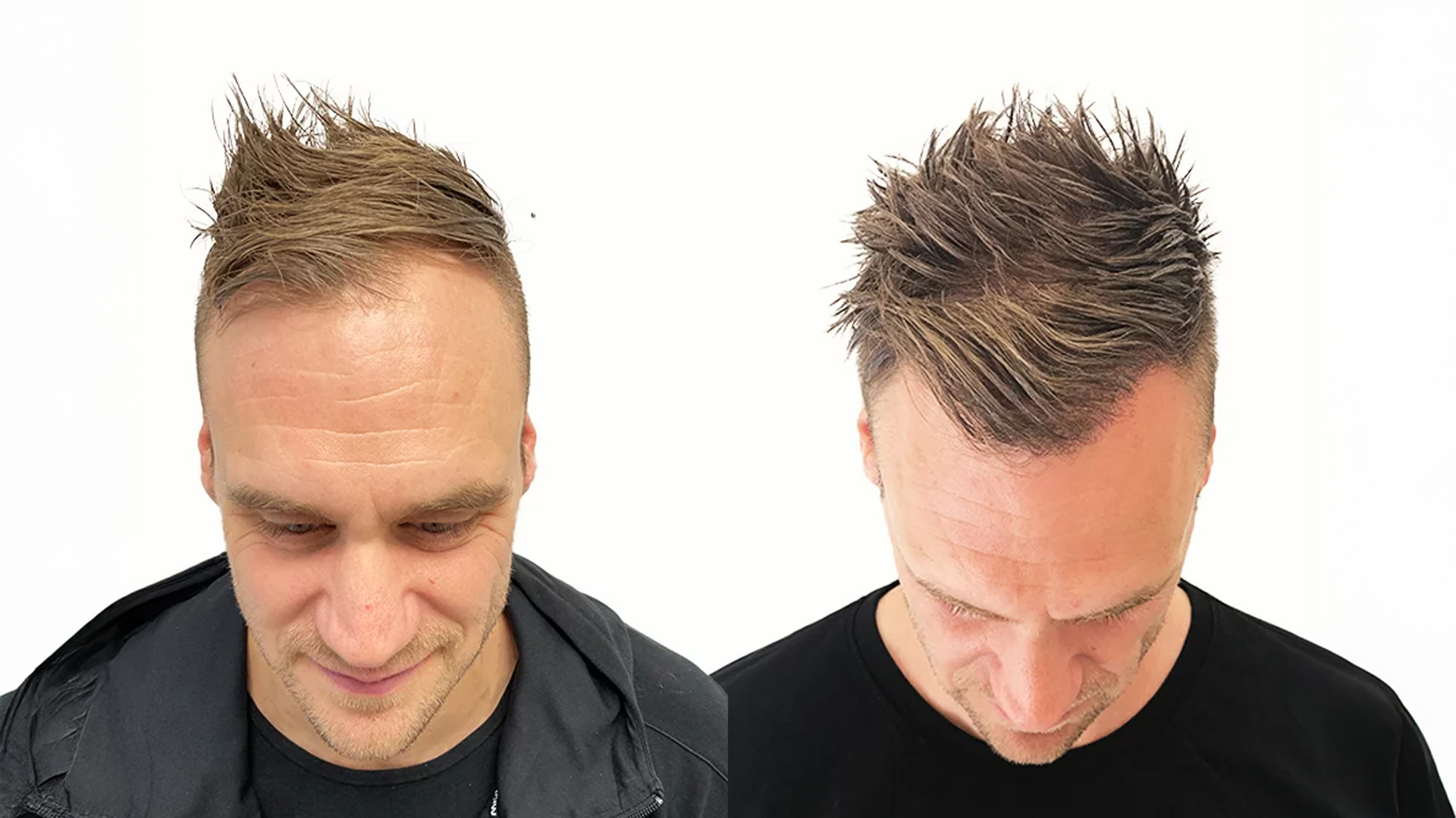 Christer – före och efter sin hårtransplantation