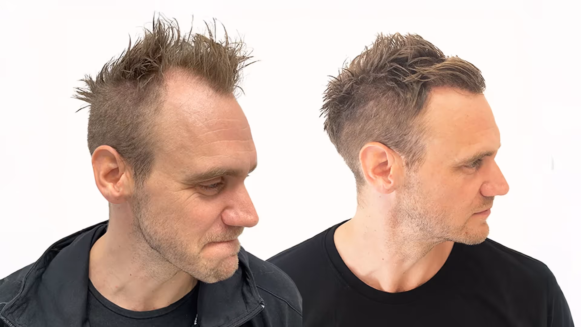Christer – före och efter sin hårtransplantation