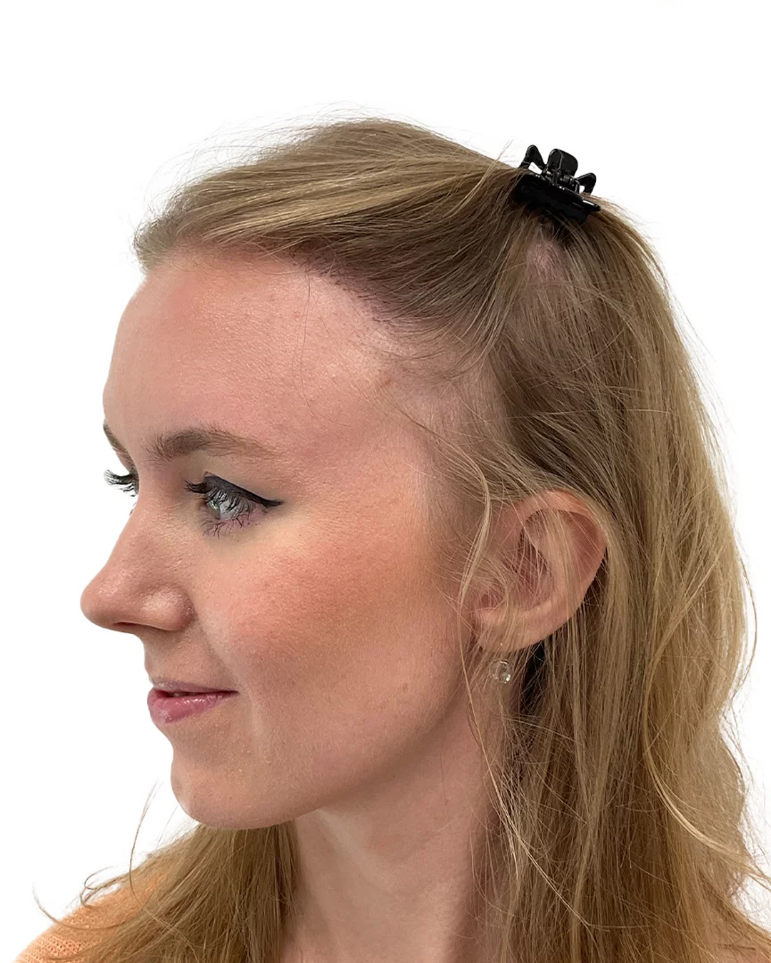 Caroline efter hårtransplantationen