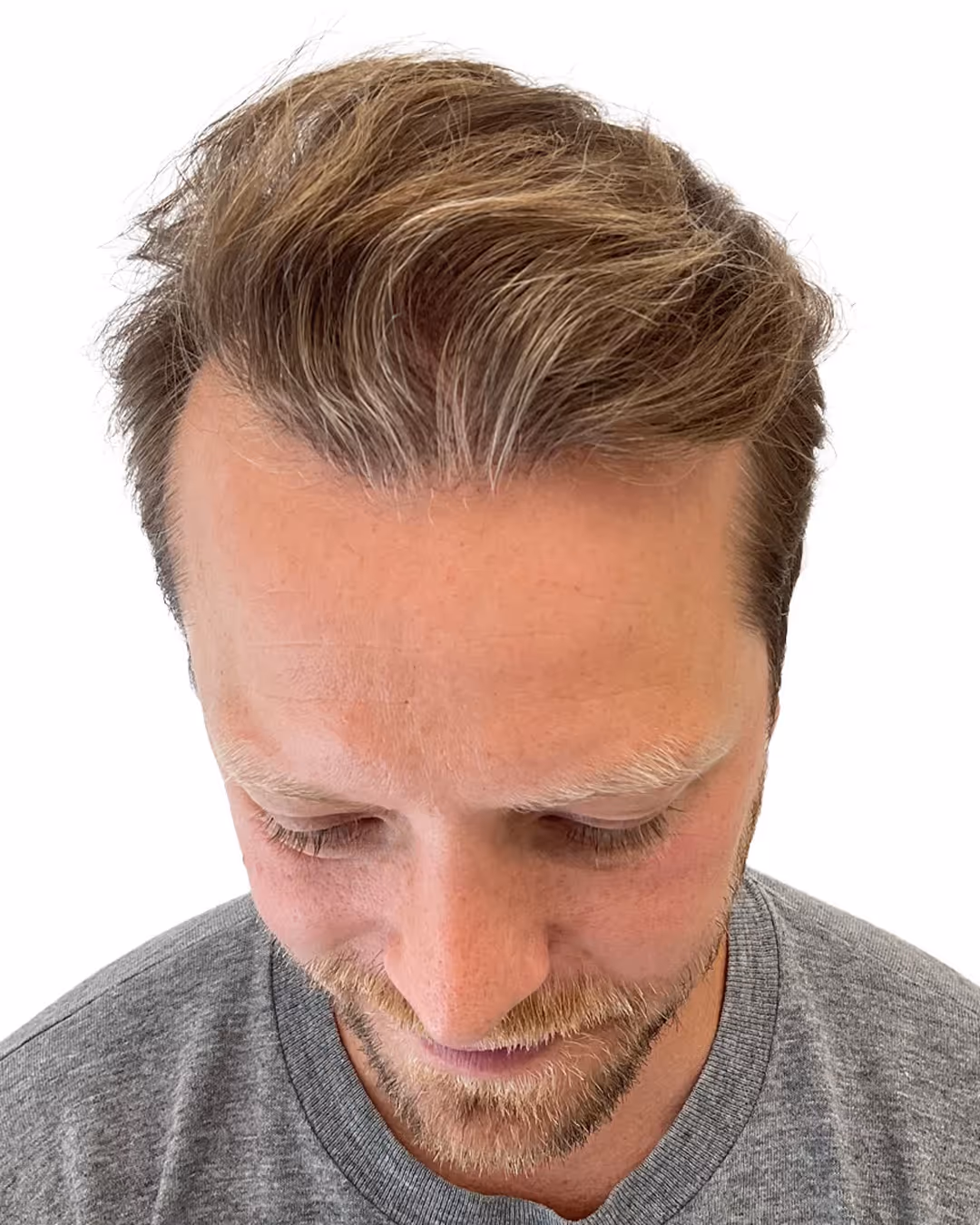 Carl-Johan efter hårtransplantationen