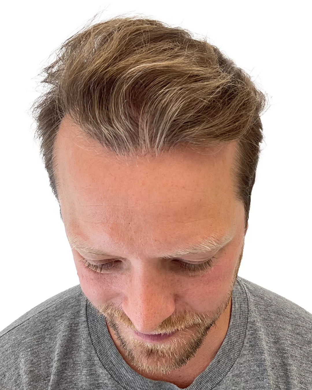 Carl-Johan efter hårtransplantationen