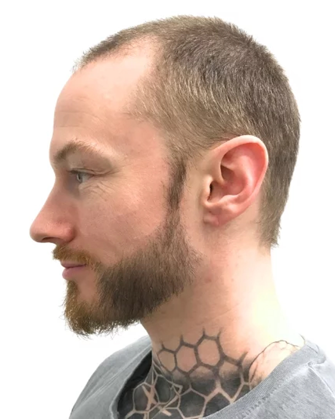 Carl efter skäggtransplantationen