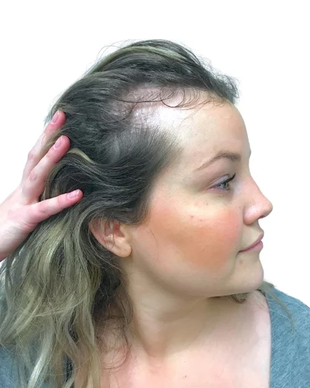 Camilla före hårtransplantationen