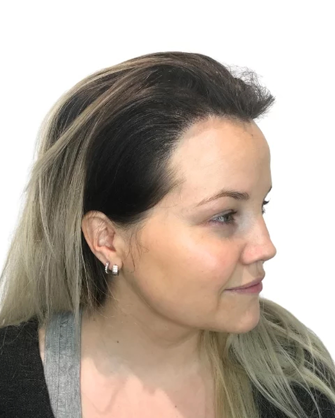 Camilla efter hårtransplantationen