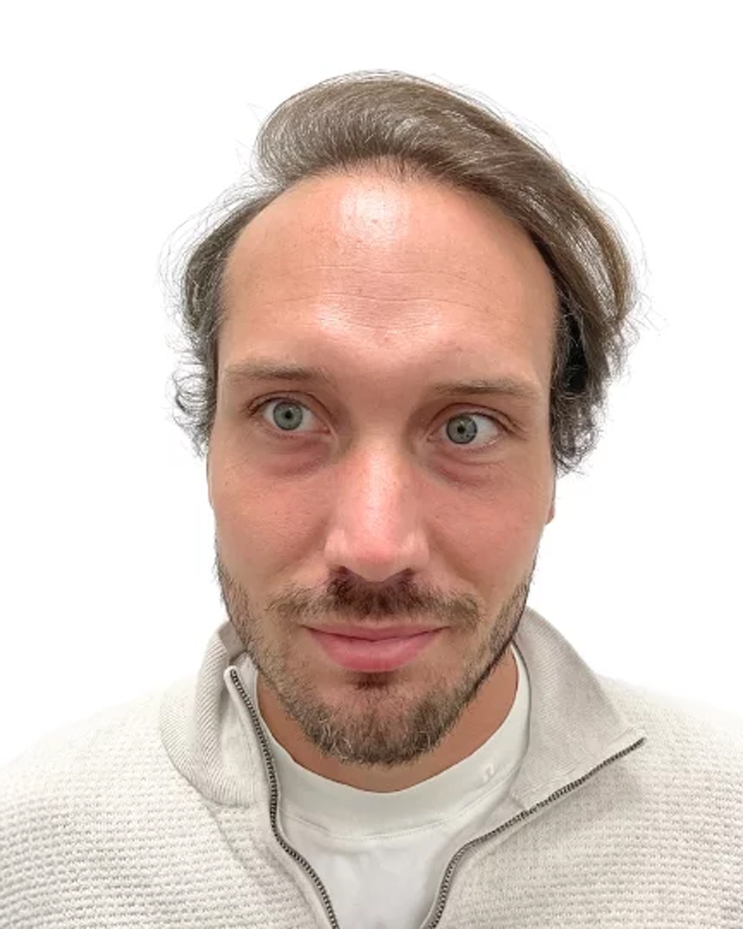 Buster efter hårtransplantationen