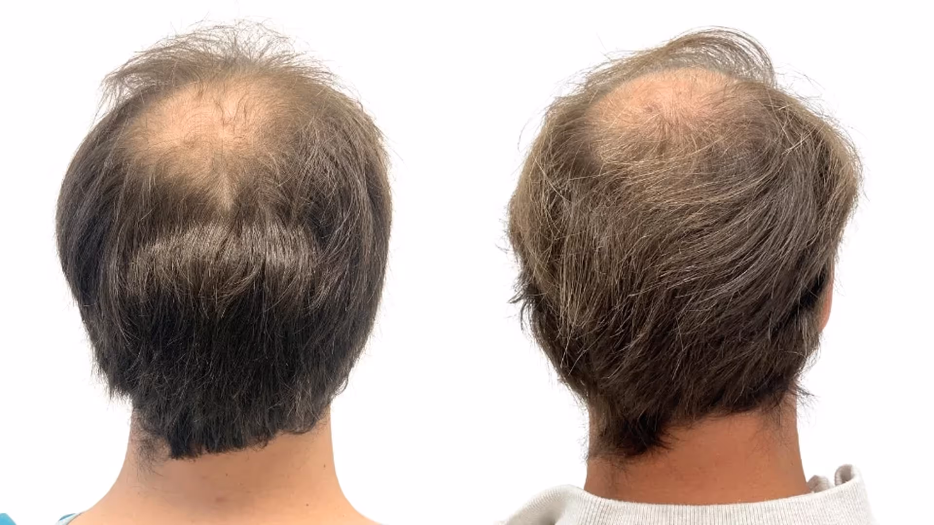 Buster – före och efter sin hårtransplantation
