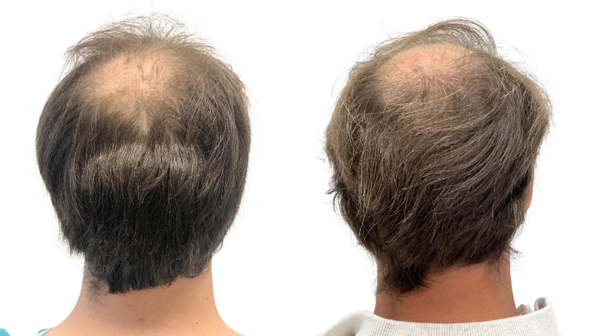 Buster – före och efter sin hårtransplantation