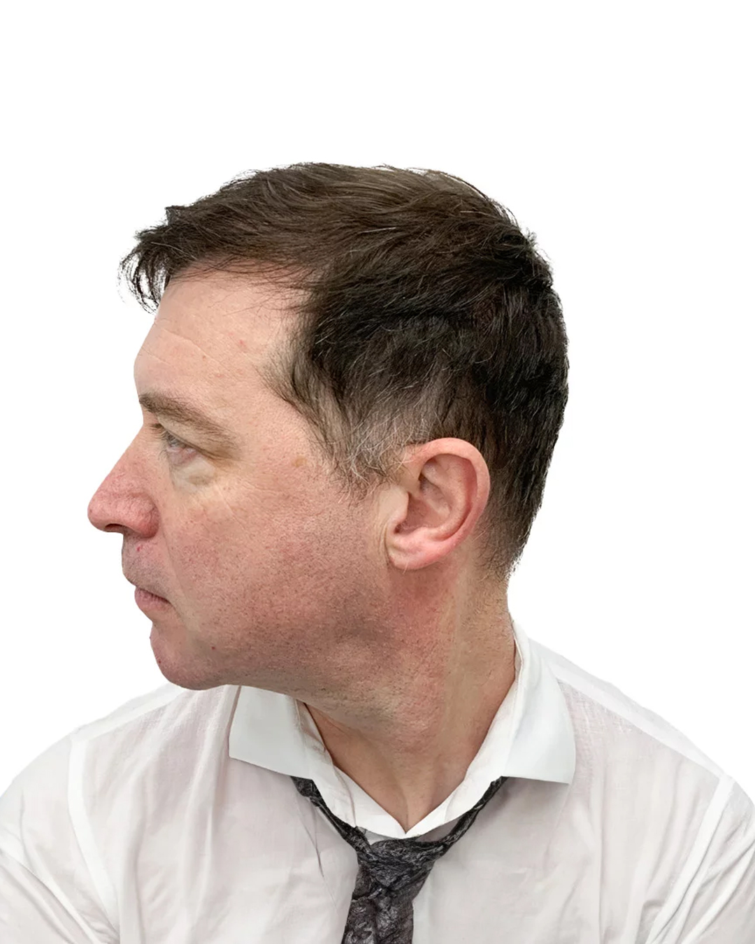 Brian efter hårtransplantationen