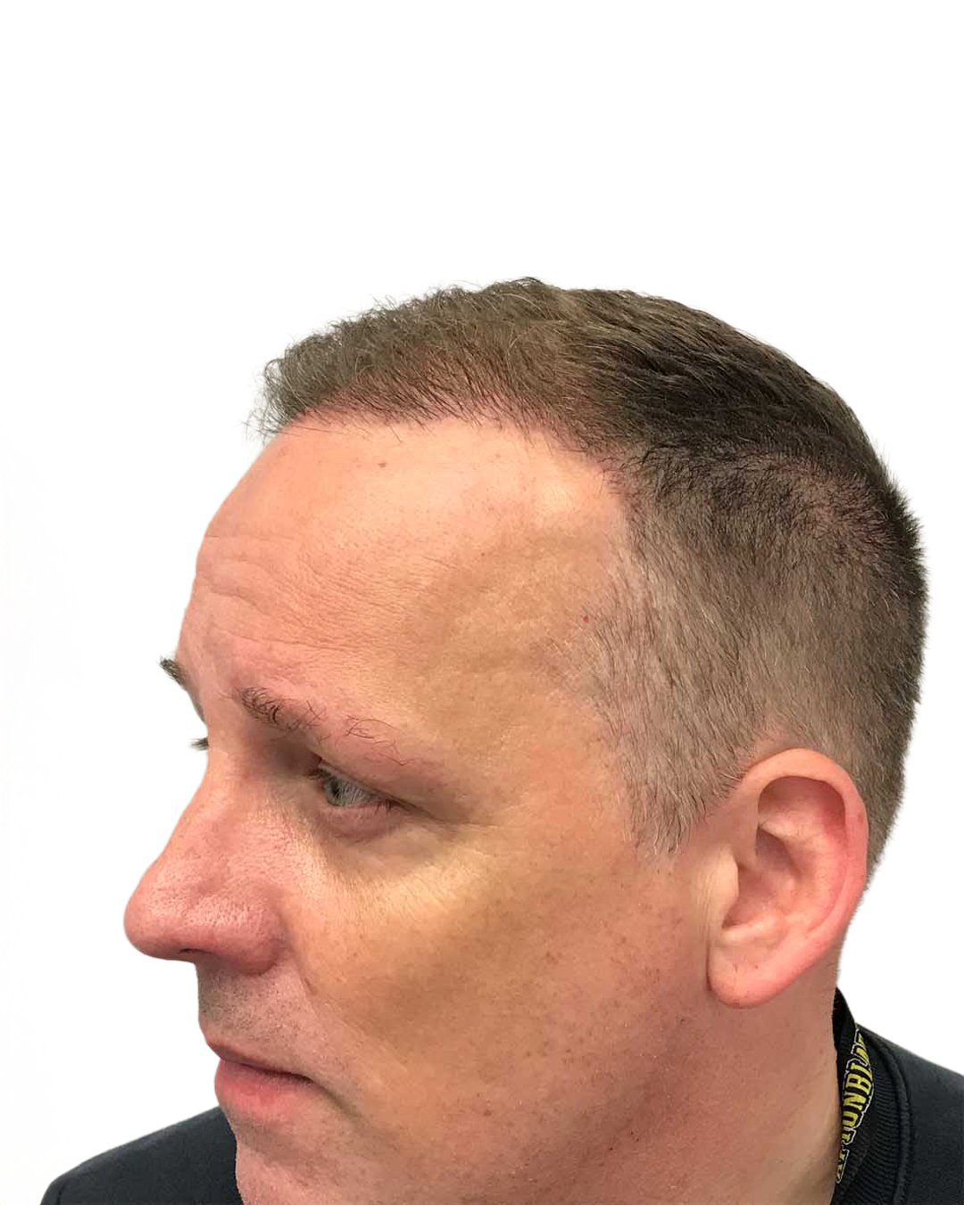 Benjamin efter hårtransplantationen