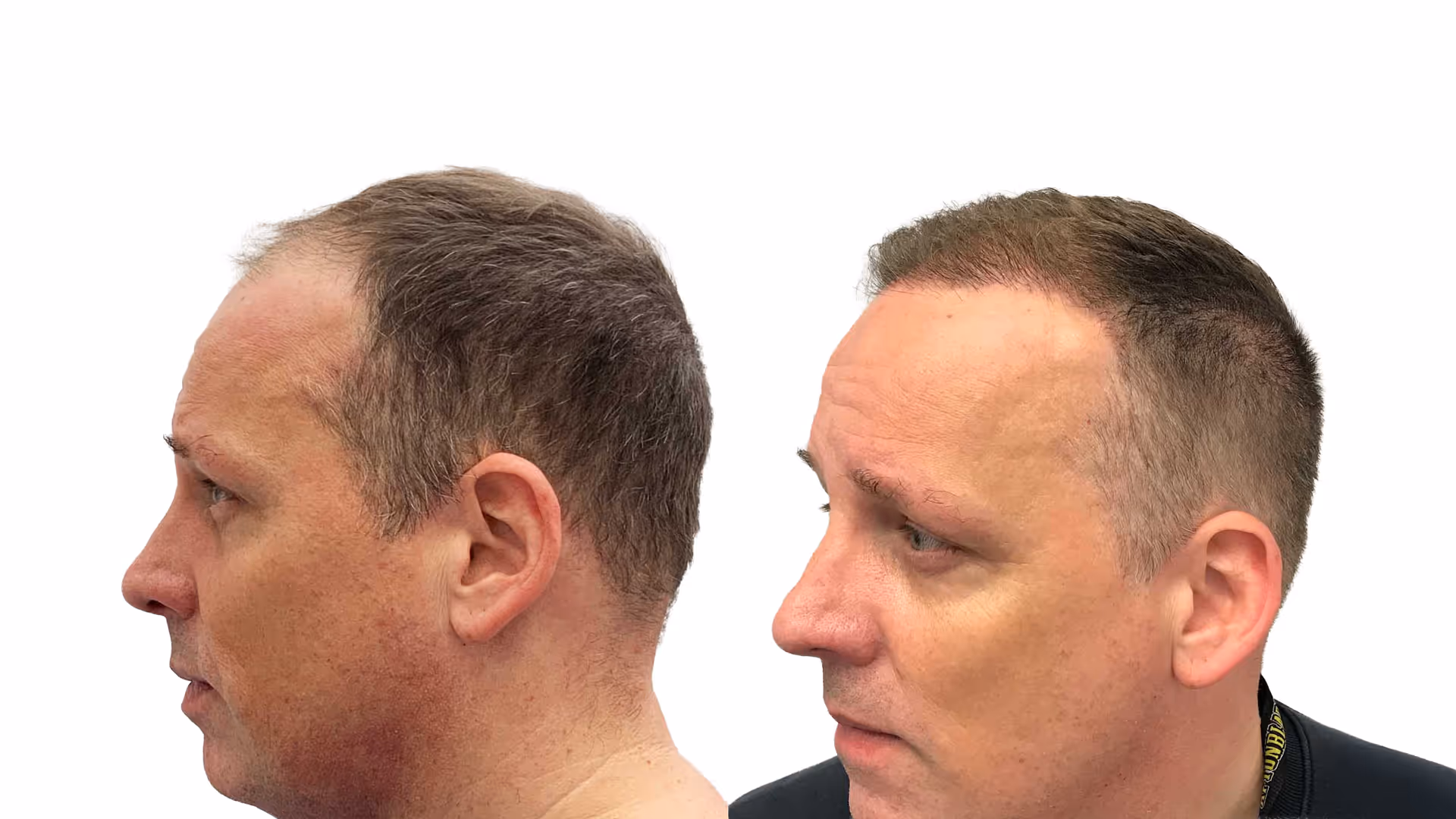 Benjamin – före och efter sin hårtransplantation
