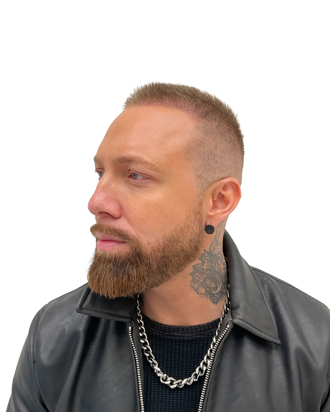 Benjamin efter hårtransplantationen