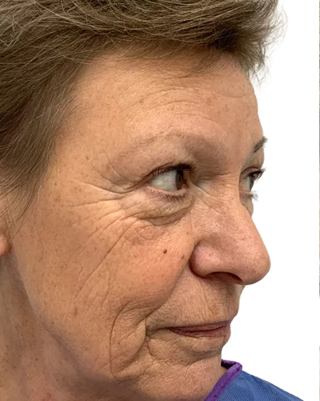 Barbro före ögonbrynstransplantationen