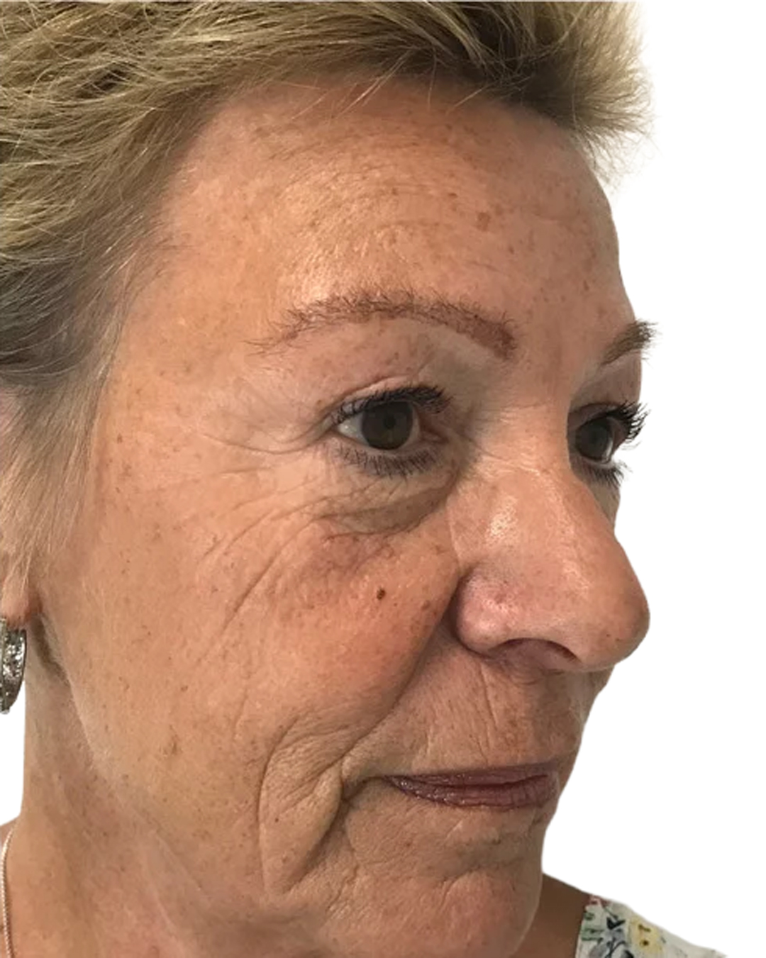 Barbro efter ögonbrynstransplantationen