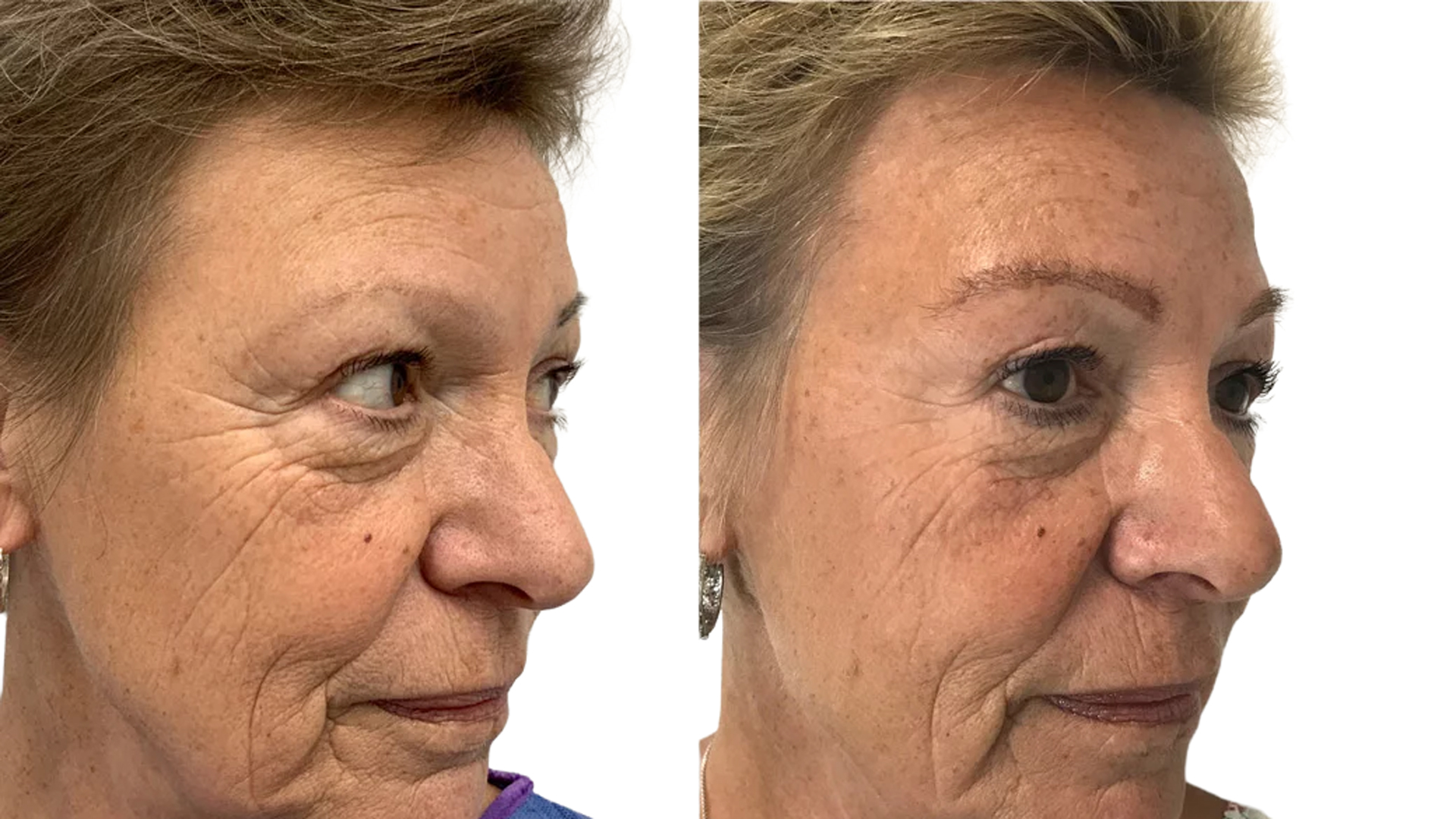 Ari – före och efter sin ögonbrynstransplantation