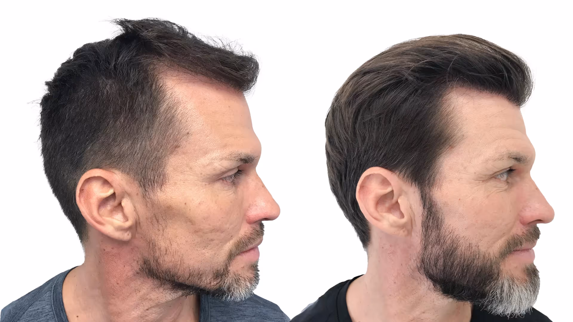 Ari – före och efter sin skäggtransplantation