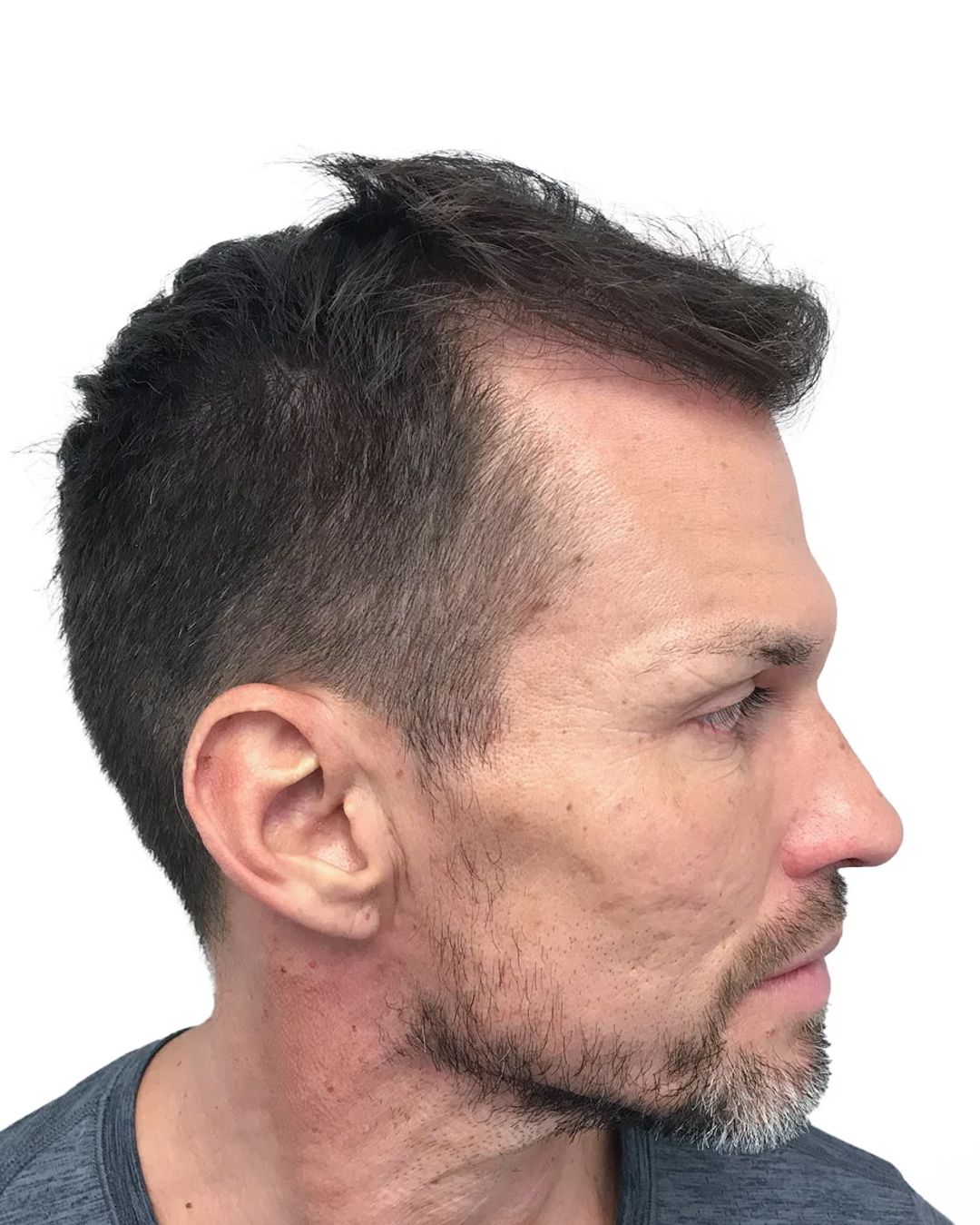 Ari före skäggtransplantationen